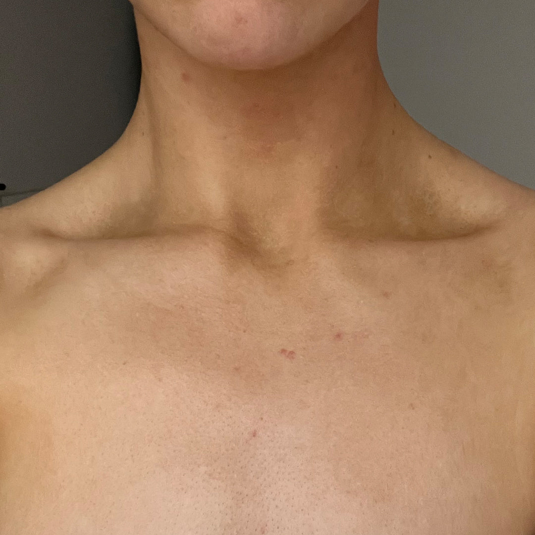 After using frank body Niacinamide Body Scrub: clearer, calmer skin across the chest and decolletage.